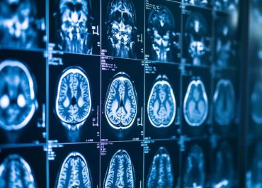 MRIs With AI-Enhanced Potential for Brain Abnormality Detection