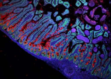 Understanding of Disease is Transformed by the Human Cell Atlas